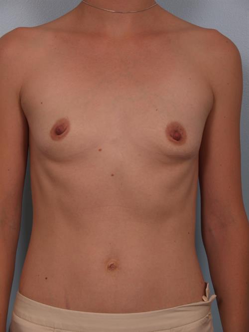Breast Augmentation Before Photo | Phoenix and Scottsdale, AZ | Scottsdale Center for Plastic Surgery
