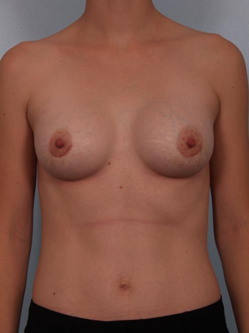 Breast Augmentation After Photo | Phoenix and Scottsdale, AZ | Scottsdale Center for Plastic Surgery
