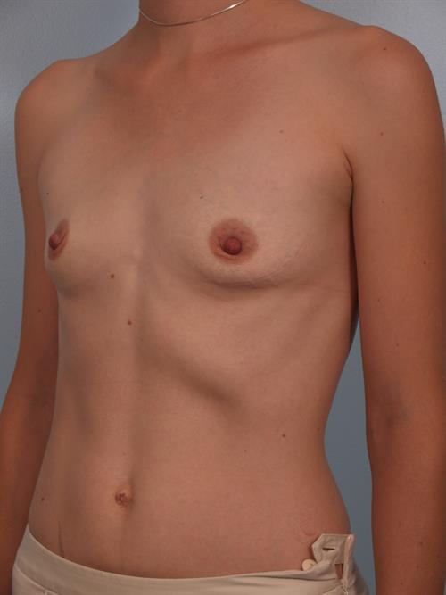 Breast Augmentation Before Photo | Phoenix and Scottsdale, AZ | Scottsdale Center for Plastic Surgery