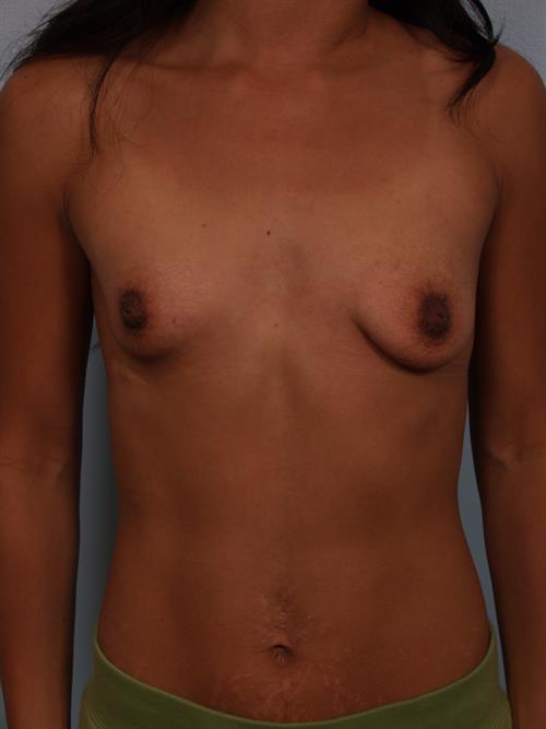 Breast Lift (Mastopexy) Before Photo | Phoenix and Scottsdale, AZ | Scottsdale Center for Plastic Surgery
