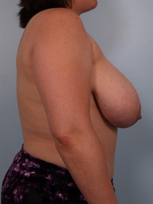 Mommy Makeover Before Photo | Phoenix and Scottsdale, AZ | Scottsdale Center for Plastic Surgery