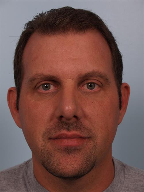 Chin Augmentation After Photo | Phoenix and Scottsdale, AZ | Scottsdale Center for Plastic Surgery