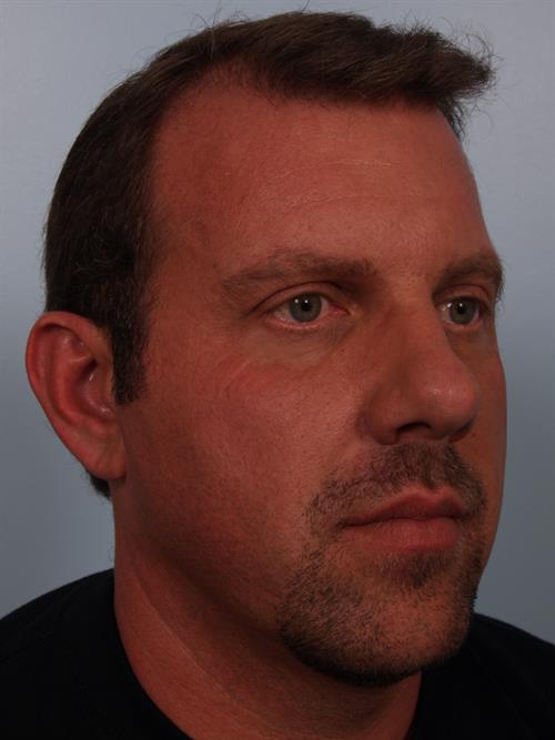 Chin Augmentation Before Photo | Phoenix and Scottsdale, AZ | Scottsdale Center for Plastic Surgery