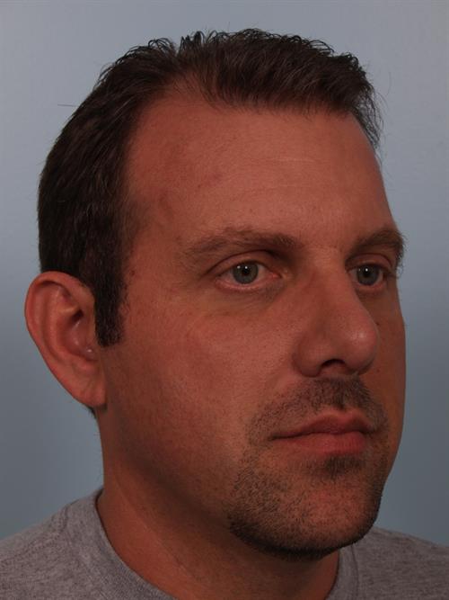 Chin Augmentation After Photo | Phoenix and Scottsdale, AZ | Scottsdale Center for Plastic Surgery