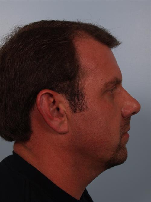 Chin Augmentation Before Photo | Phoenix and Scottsdale, AZ | Scottsdale Center for Plastic Surgery