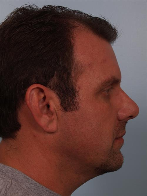 Chin Augmentation After Photo | Phoenix and Scottsdale, AZ | Scottsdale Center for Plastic Surgery