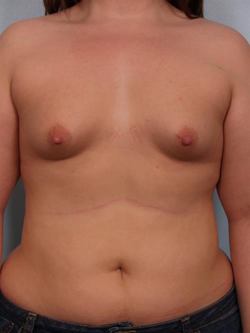 Tuberous Breast Surgery Before Photo | Phoenix and Scottsdale, AZ | Scottsdale Center for Plastic Surgery