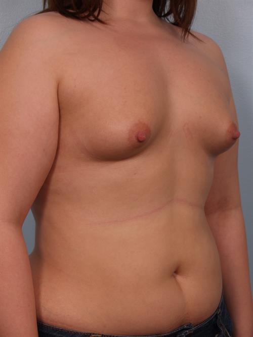 Tuberous Breast Surgery Before Photo | Phoenix and Scottsdale, AZ | Scottsdale Center for Plastic Surgery