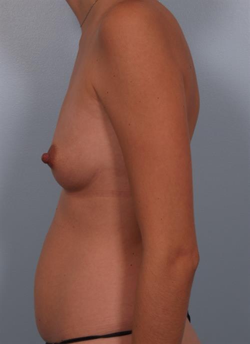 Power Assisted Liposuction Before Photo | Phoenix and Scottsdale, AZ | Scottsdale Center for Plastic Surgery