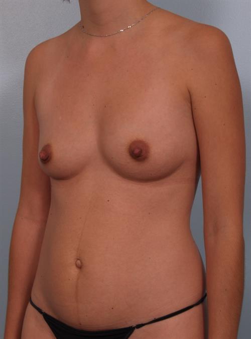 Power Assisted Liposuction Before Photo | Phoenix and Scottsdale, AZ | Scottsdale Center for Plastic Surgery