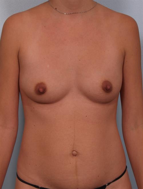 Power Assisted Liposuction Before Photo | Phoenix and Scottsdale, AZ | Scottsdale Center for Plastic Surgery