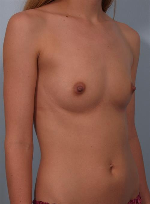 Breast Augmentation Before Photo | Phoenix and Scottsdale, AZ | Scottsdale Center for Plastic Surgery
