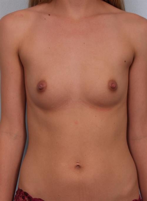 Breast Augmentation Before Photo | Phoenix and Scottsdale, AZ | Scottsdale Center for Plastic Surgery