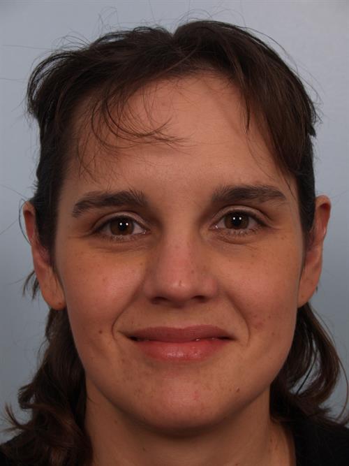 Otoplasty (Ear Reshaping) After Photo | Phoenix and Scottsdale, AZ | Scottsdale Center for Plastic Surgery