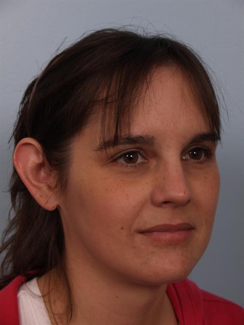 Otoplasty (Ear Reshaping) Before Photo | Phoenix and Scottsdale, AZ | Scottsdale Center for Plastic Surgery