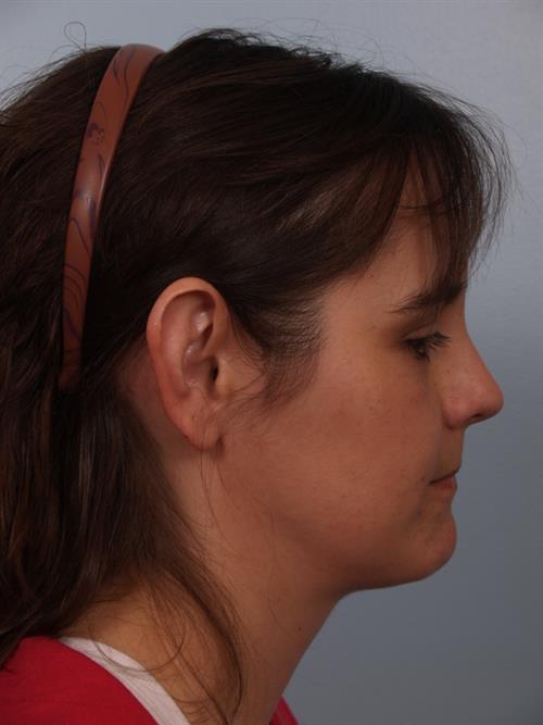 Otoplasty (Ear Reshaping) Before Photo | Phoenix and Scottsdale, AZ | Scottsdale Center for Plastic Surgery