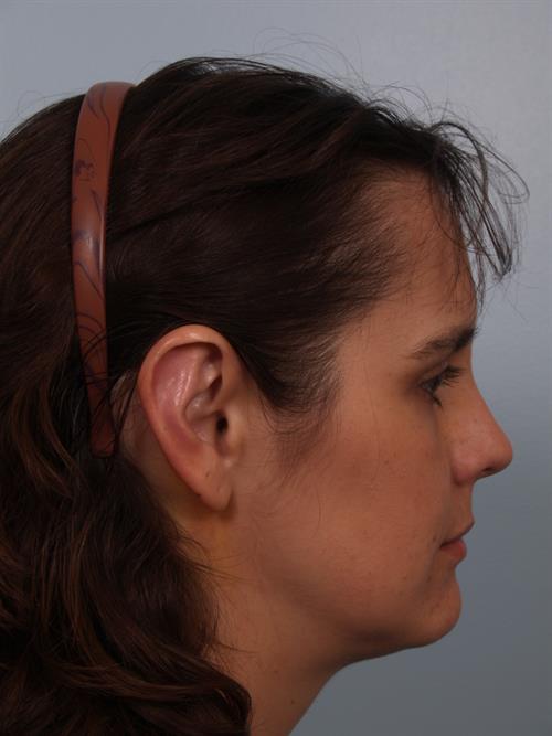 Otoplasty (Ear Reshaping) After Photo | Phoenix and Scottsdale, AZ | Scottsdale Center for Plastic Surgery