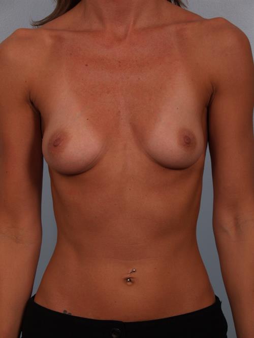 Breast Augmentation Before Photo | Phoenix and Scottsdale, AZ | Scottsdale Center for Plastic Surgery