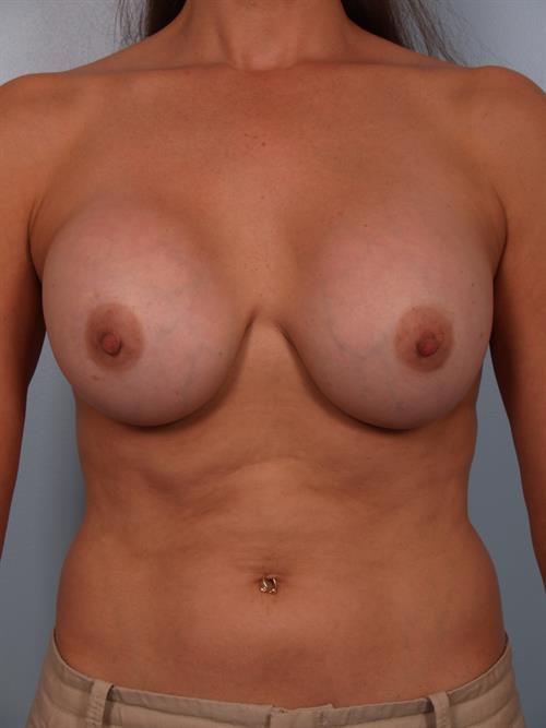 Revision Breast Surgery Before Photo | Phoenix and Scottsdale, AZ | Scottsdale Center for Plastic Surgery