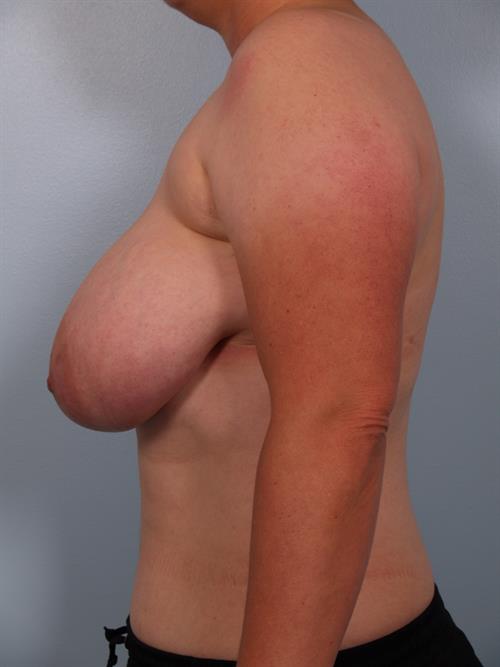 Breast Reduction Before Photo | Phoenix and Scottsdale, AZ | Scottsdale Center for Plastic Surgery