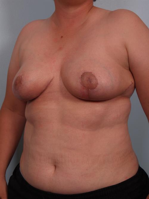 Breast Reduction After Photo | Phoenix and Scottsdale, AZ | Scottsdale Center for Plastic Surgery