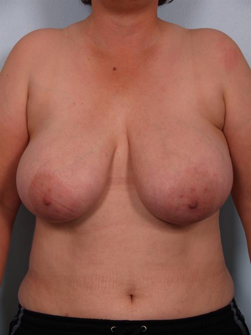 Breast Reduction Before Photo | Phoenix and Scottsdale, AZ | Scottsdale Center for Plastic Surgery