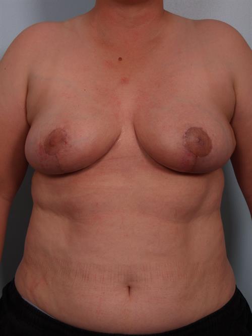 Breast Reduction After Photo | Phoenix and Scottsdale, AZ | Scottsdale Center for Plastic Surgery