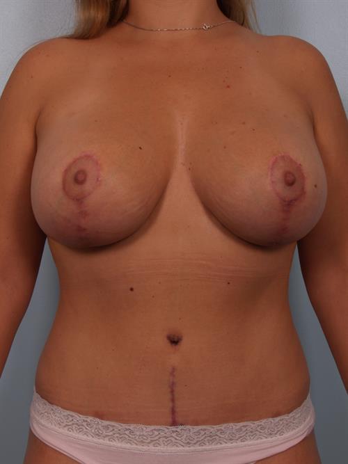Tummy Tuck After Photo | Paradise Valley, AZ | Scottsdale Center for Plastic Surgery