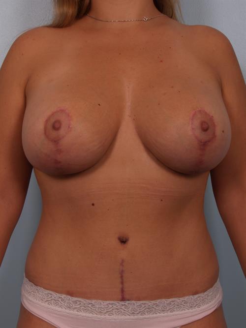 Tummy Tuck After Photo | , |