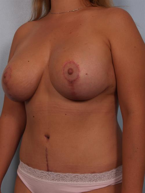 Revision Breast Surgery After Photo | ,  | 