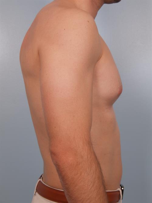 Male Breast/Areola Reduction Before Photo | Phoenix and Scottsdale, AZ | Scottsdale Center for Plastic Surgery