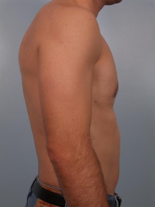 Male Breast/Areola Reduction After Photo | Phoenix and Scottsdale, AZ | Scottsdale Center for Plastic Surgery