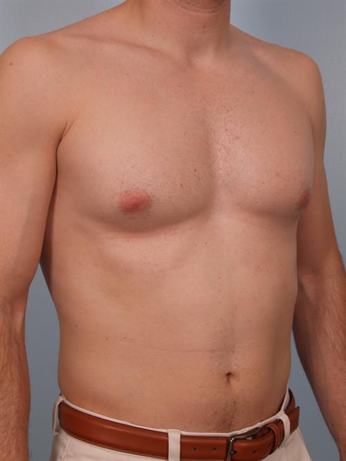Male Breast/Areola Reduction Before Photo | Phoenix and Scottsdale, AZ | Scottsdale Center for Plastic Surgery