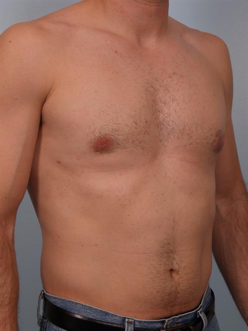Male Breast/Areola Reduction After Photo | Phoenix and Scottsdale, AZ | Scottsdale Center for Plastic Surgery