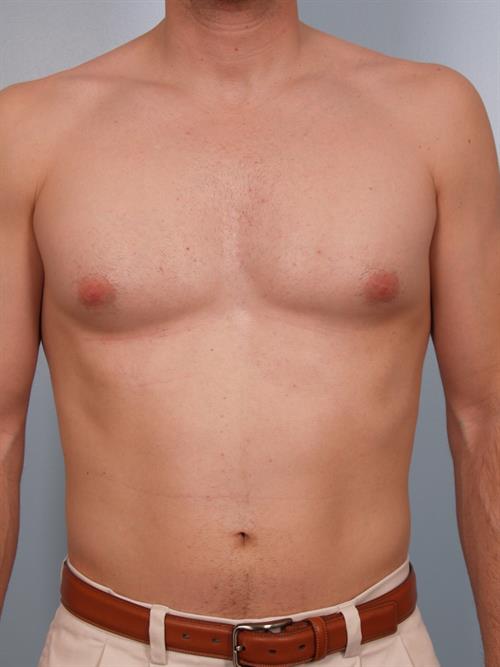 Male Liposuction Before Photo | Phoenix and Scottsdale, AZ | Scottsdale Center for Plastic Surgery