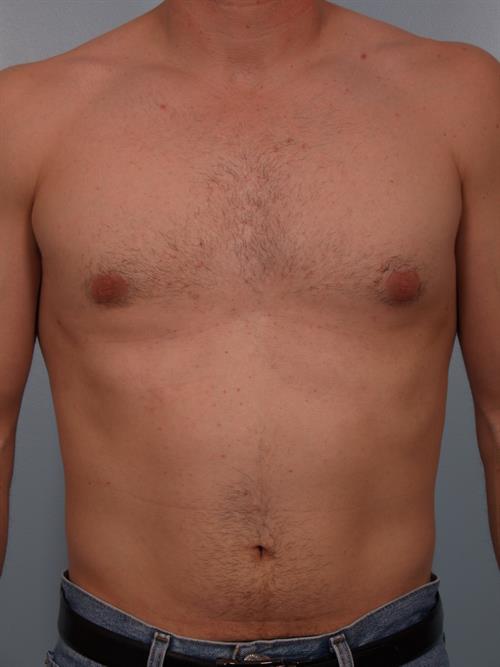 Male Liposuction After Photo | Phoenix and Scottsdale, AZ | Scottsdale Center for Plastic Surgery
