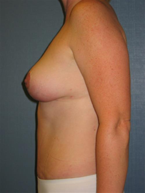 Breast Reduction After Photo | Phoenix and Scottsdale, AZ | Scottsdale Center for Plastic Surgery