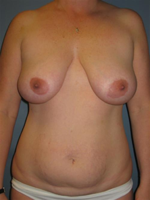 Breast Reduction Before Photo | Phoenix and Scottsdale, AZ | Scottsdale Center for Plastic Surgery