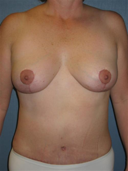Breast Reduction After Photo | Phoenix and Scottsdale, AZ | Scottsdale Center for Plastic Surgery