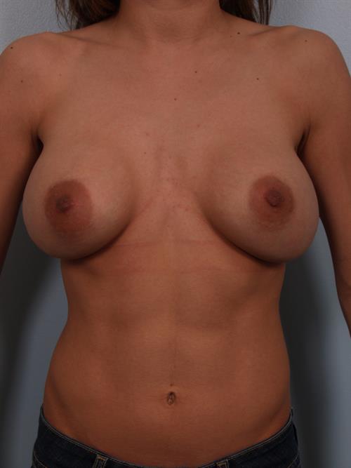 Revision Breast Surgery Before Photo | Phoenix and Scottsdale, AZ | Scottsdale Center for Plastic Surgery