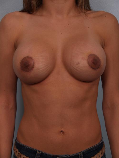 Revision Breast Surgery After Photo | Phoenix and Scottsdale, AZ | Scottsdale Center for Plastic Surgery