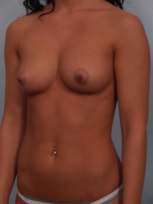 Breast Augmentation Before Photo | Phoenix and Scottsdale, AZ | Scottsdale Center for Plastic Surgery