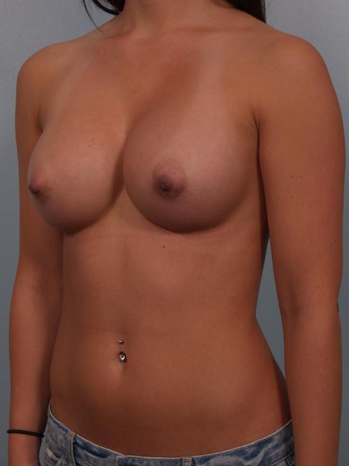 Breast Augmentation After Photo | Phoenix and Scottsdale, AZ | Scottsdale Center for Plastic Surgery