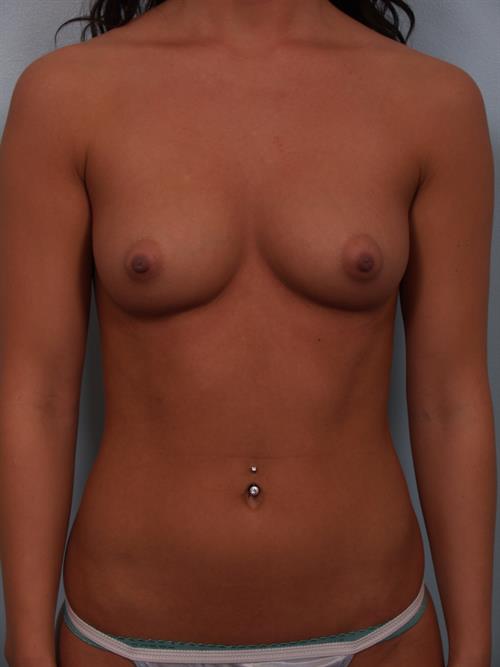 Breast Augmentation Before Photo | Phoenix and Scottsdale, AZ | Scottsdale Center for Plastic Surgery