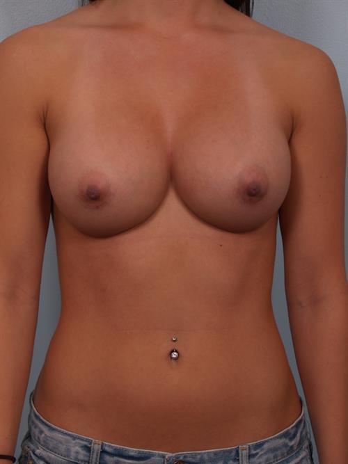 Breast Augmentation After Photo | Phoenix and Scottsdale, AZ | Scottsdale Center for Plastic Surgery