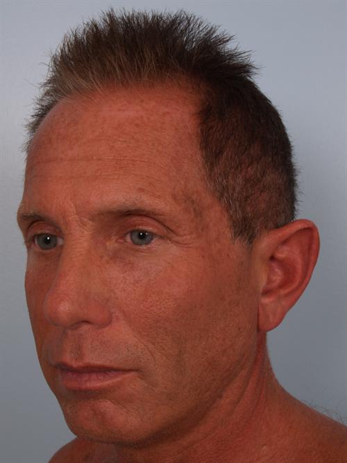 Otoplasty (Ear Reshaping) Before Photo | Phoenix and Scottsdale, AZ | Scottsdale Center for Plastic Surgery