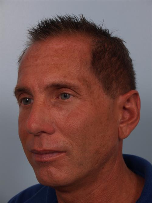 Otoplasty (Ear Reshaping) After Photo | Phoenix and Scottsdale, AZ | Scottsdale Center for Plastic Surgery
