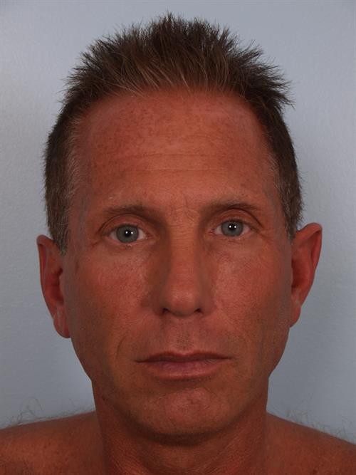 Otoplasty (Ear Reshaping) Before Photo | Phoenix and Scottsdale, AZ | Scottsdale Center for Plastic Surgery