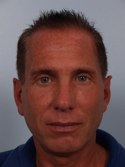 Otoplasty (Ear Reshaping) After Photo | Phoenix and Scottsdale, AZ | Scottsdale Center for Plastic Surgery