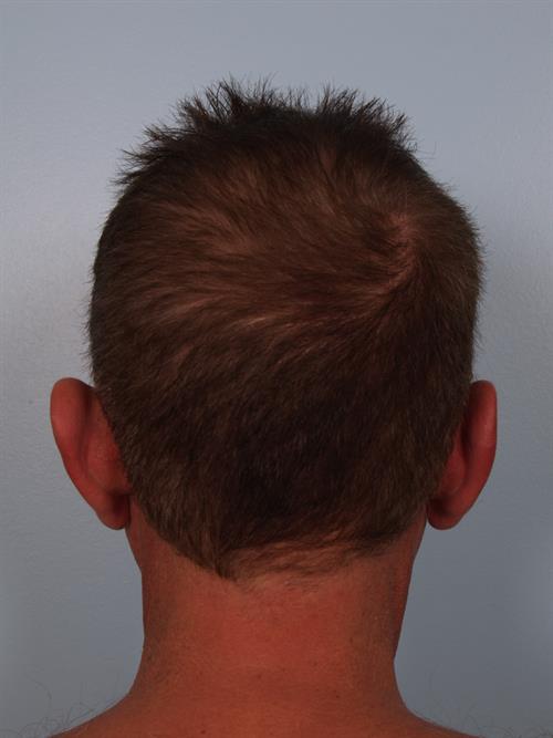 Otoplasty (Ear Reshaping) Before Photo | Phoenix and Scottsdale, AZ | Scottsdale Center for Plastic Surgery